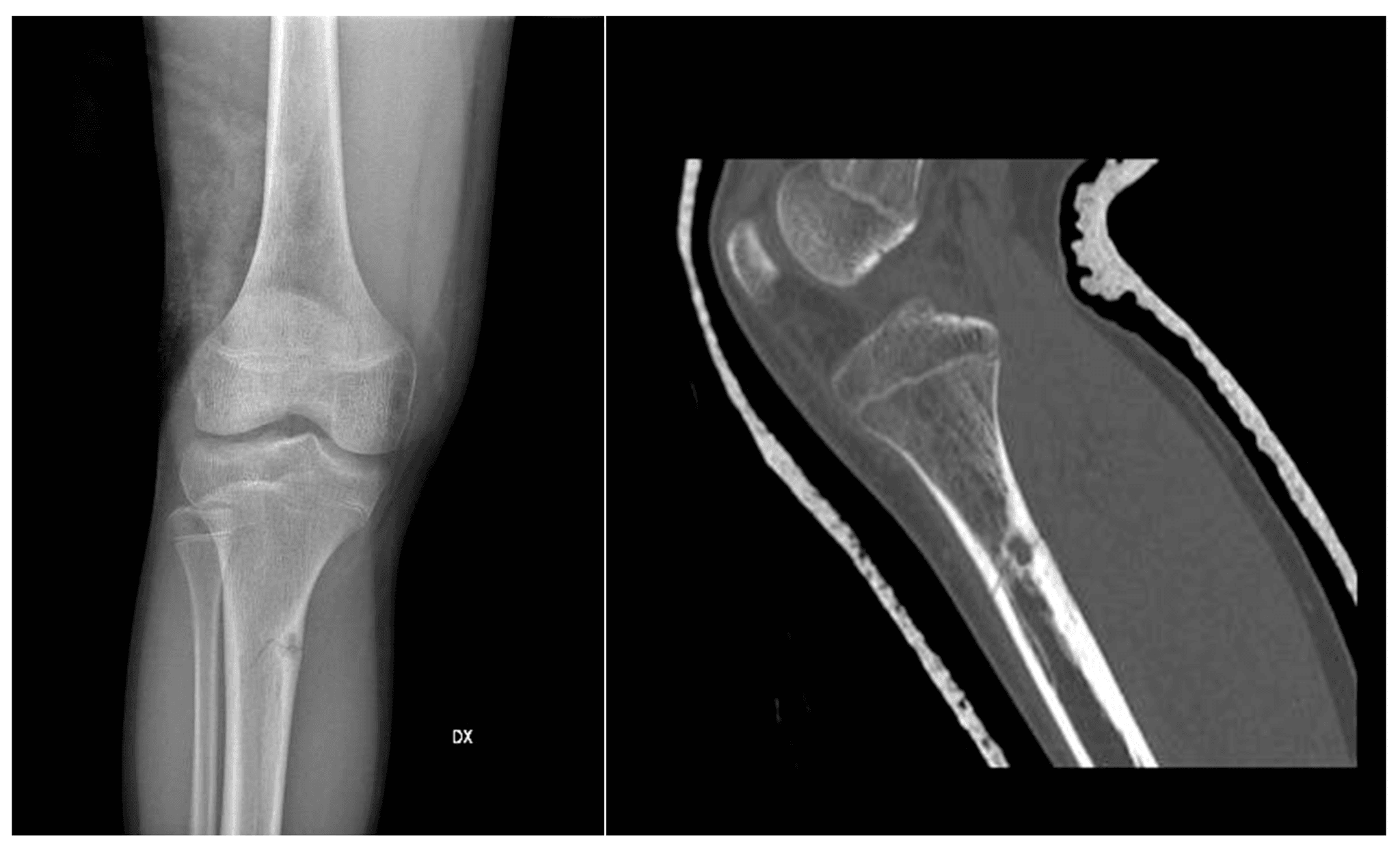 bone-tumors